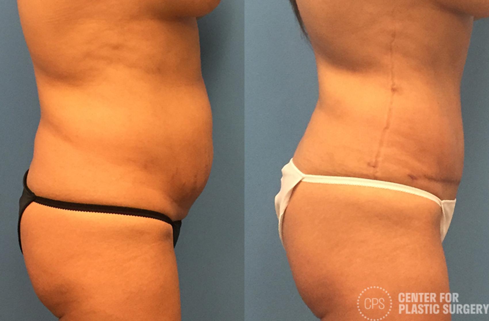 Tummy Tuck Case 65 Before & After Right Side | Annandale, Washington D.C. Metropolitan Area | Center for Plastic Surgery